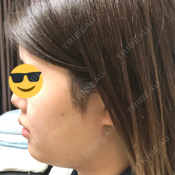 バッカルファット除去 / 脂肪吸引（顔） 湘南美容クリニック 秋葉原院 BEFORE メイン用
