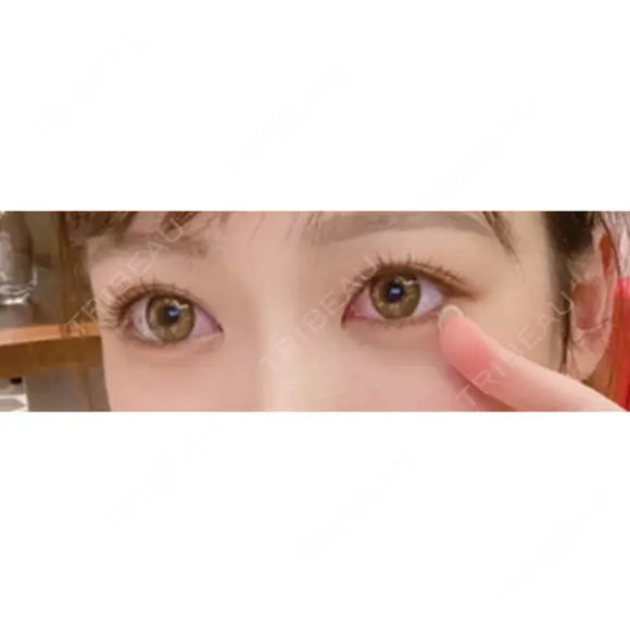 二重切開 / タレ目形成・グラマラスライン（切開） ハナキクリニック BEFORE メイン用