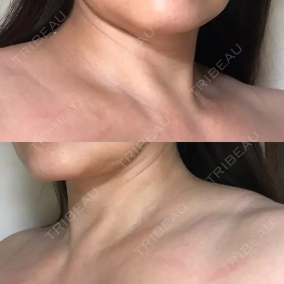 ボトックス（肩） 湘南美容クリニック 奈良院 BEFORE メイン用