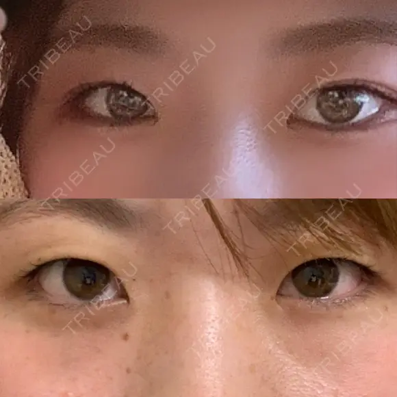 二重埋没 R.O.clinic BEFORE メイン用