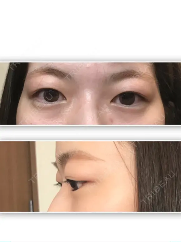 二重埋没 / 上まぶたの脂肪取り / 眉下切開 湘南美容クリニック 高田馬場院 BEFORE メイン用