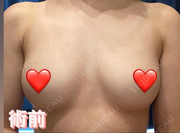 脂肪吸引（脚） / 脂肪吸引（お尻） / 豊胸（脂肪注入） / 脂肪注入（額） 湘南美容クリニック 自由が丘院 BEFORE メイン用