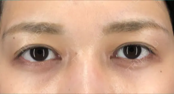 蒙古ひだ形成 R.O.clinic BEFORE メイン用