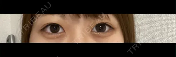 二重埋没 ながしまクリニック BEFORE メイン用