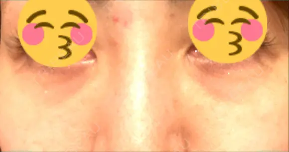 クマ治療 / 再生医療 / PRP皮膚再生療法 銀座よしえクリニック 銀座院 BEFORE メイン用
