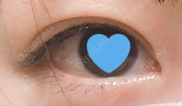 二重切開 / 目元修正 水の森美容クリニック 名古屋院 BEFORE メイン用