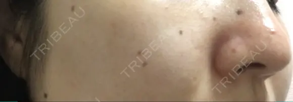 ほくろ・いぼ切除（肌） / ほくろ・いぼ除去レーザー（肌） 赤坂メディカルMクリニック BEFORE メイン用