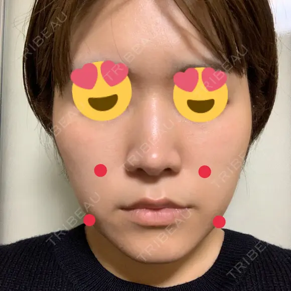 脂肪溶解注射（顔） 赤坂プレミアクリニック BEFORE メイン用