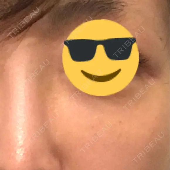 シミ取りレーザー / 美白レーザー / YAGレーザー / その他（目元） YAG BEAUTY CLINIC TOKYO  BEFORE メイン用