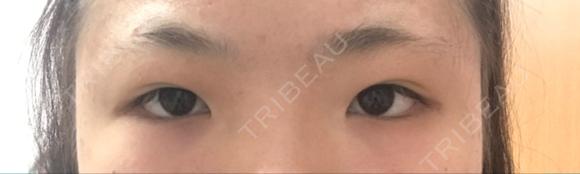 二重埋没 / 目頭切開 湘南美容クリニック 京都院 BEFORE メイン用