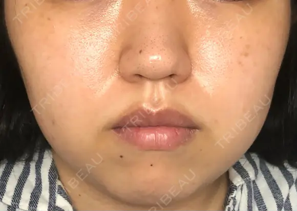 シミ取りレーザー / ピコレーザートーニング（美白・肝斑） UB CLINIC銀座 BEFORE メイン用