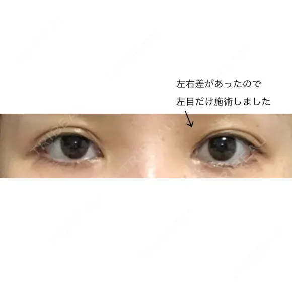 二重埋没 / 自然癒着法 表参道スキンクリニック 名古屋院（DAILY SKIN CLINIC提携院） BEFORE メイン用