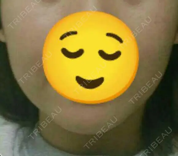 脂肪溶解注射（顔） 赤坂プレミアクリニック BEFORE メイン用