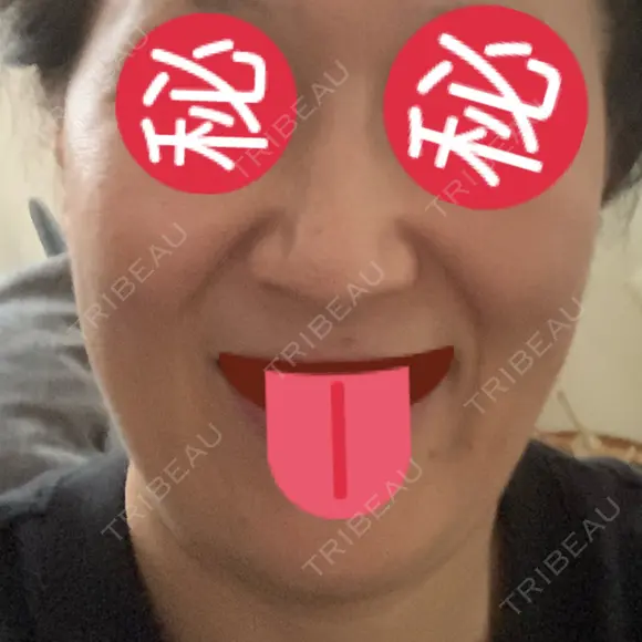 ボトックス（エラ・小顔） 湘南美容クリニック 藤沢院 BEFORE メイン用