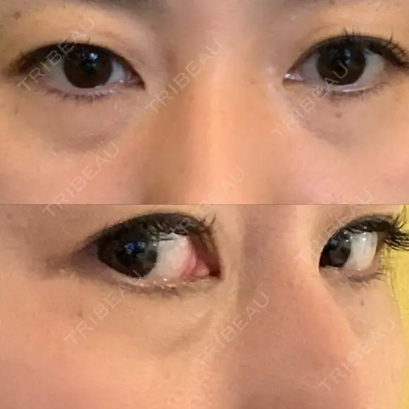 クマ治療 / 下まぶたたるみ取り / 下まぶたの脂肪取り 品川美容外科 渋谷院（※品川スキンクリニック提携） BEFORE メイン用