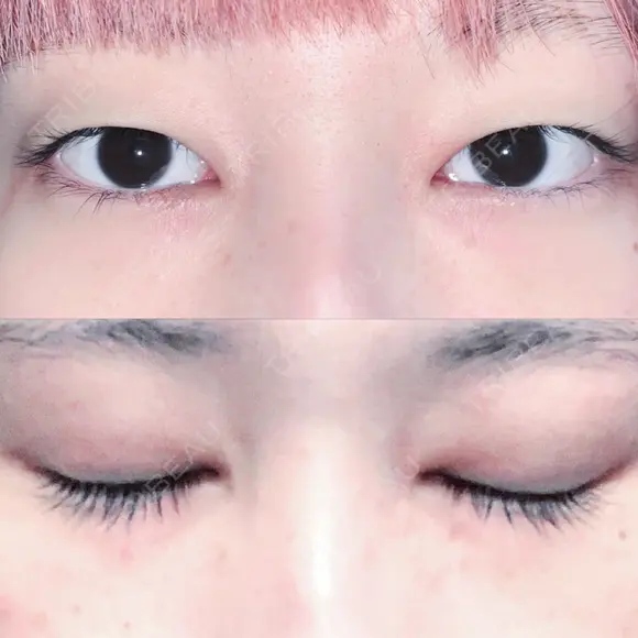 二重切開 松下皮フ形成外科 BEFORE メイン用