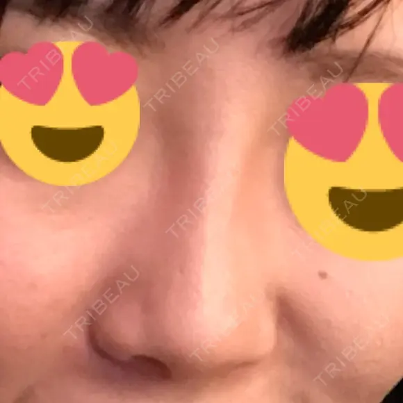 鼻尖形成（切開） / 鼻中隔延長（切開） / 軟骨移植 / 鼻翼基部形成（貴族手術） HANABI整形外科 BEFORE メイン用