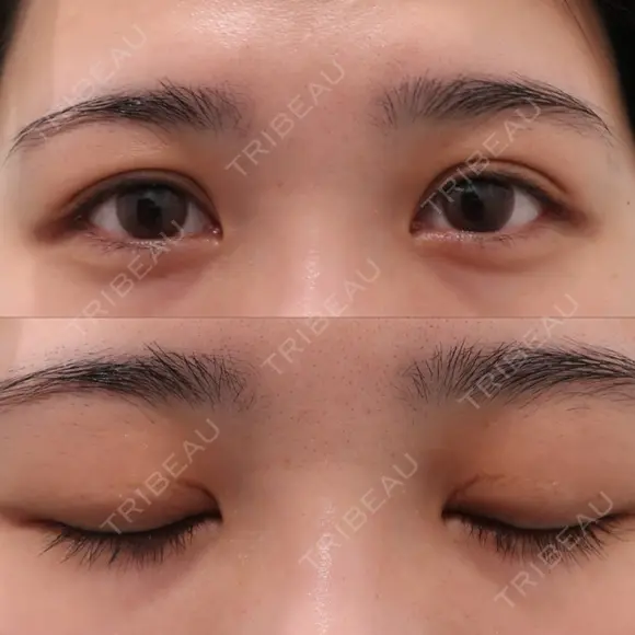 上まぶたの脂肪取り / 眉下切開 WOM CLINIC GINZA （ワム クリニック ギンザ） BEFORE メイン用