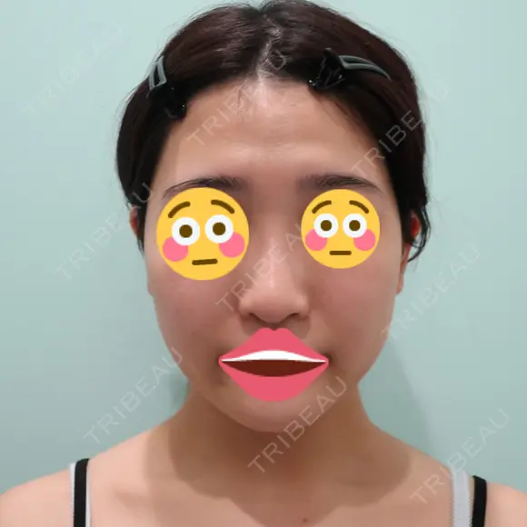 糸リフト / バッカルファット除去 / 脂肪吸引（顔） / ボトックス（エラ・小顔） WOM CLINIC GINZA （ワム クリニック ギンザ） BEFORE メイン用