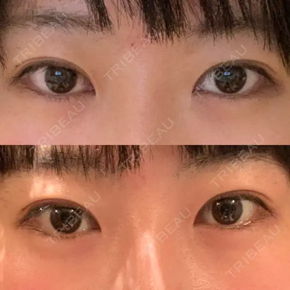 二重埋没 湘南美容クリニック Regno 銀座院 BEFORE メイン用