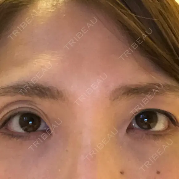 二重切開 / 眼瞼下垂（切開） / 上まぶたたるみ取り 湘南美容クリニック 高田馬場院 BEFORE メイン用