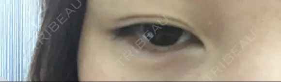 眼瞼下垂（切開） なでしこ皮膚科クリニック BEFORE メイン用