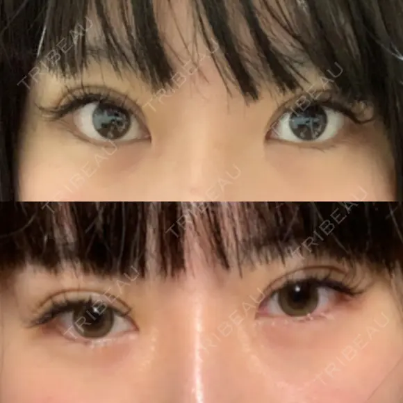 ヒアルロン酸注入（涙袋） 聖心美容クリニック 大阪院 BEFORE メイン用