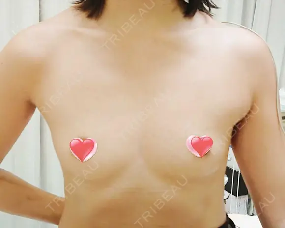 豊胸（シリコンバッグ） 表参道スキンクリニック 名古屋院（DAILY SKIN CLINIC提携院） BEFORE メイン用