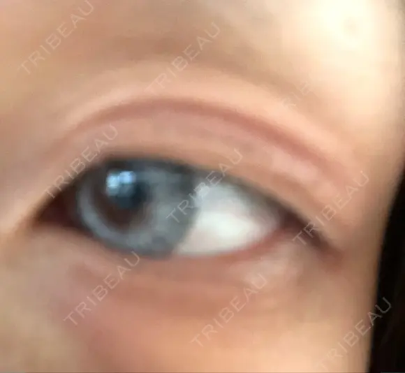 二重埋没 メディカルビューティセンター BEFORE メイン用