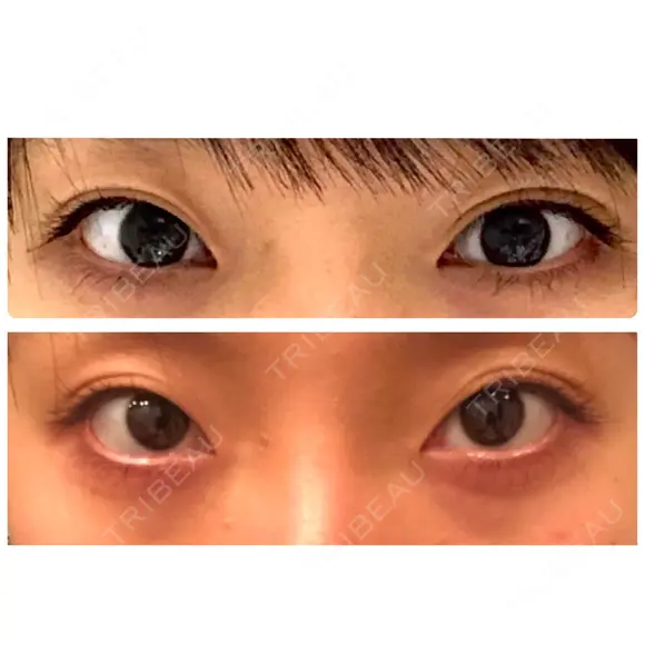 二重埋没 表参道スキンクリニック 表参道院 BEFORE メイン用