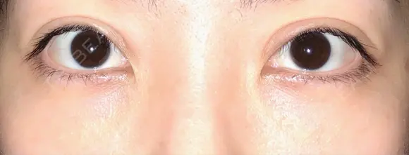 二重切開 / 眼瞼下垂（切開） / 目元修正 トップフェイス整形外科 BEFORE メイン用