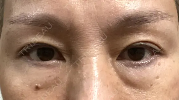 下まぶたたるみ取り / 下まぶたの脂肪取り ヨーダー公子クリニック眼科・美容皮膚科 横浜六浦院 BEFORE メイン用