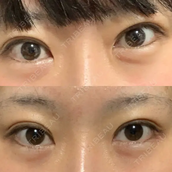蒙古ひだ形成 R.O.clinic BEFORE メイン用