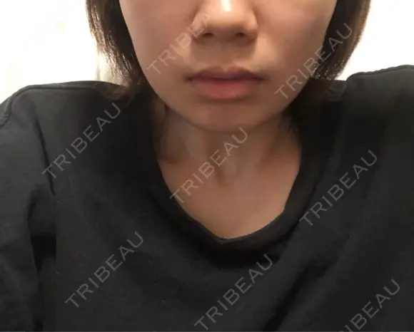 糸リフト / バッカルファット除去 / ボトックス（エラ・小顔） / ヒアルロン酸注入（頬） 湘南美容クリニック 横浜院 BEFORE メイン用