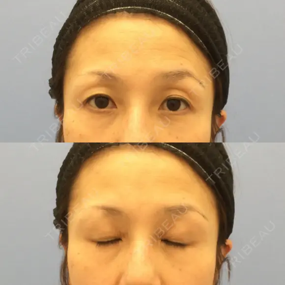 目尻切開 湘南美容クリニック 秋葉原院 BEFORE メイン用