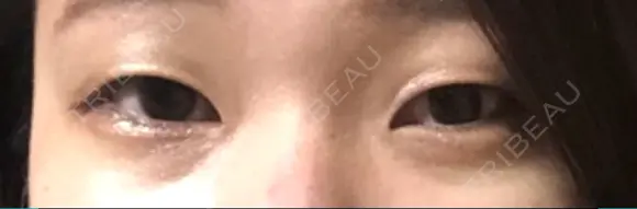 自然癒着法 マーブル美容整形外科 BEFORE メイン用