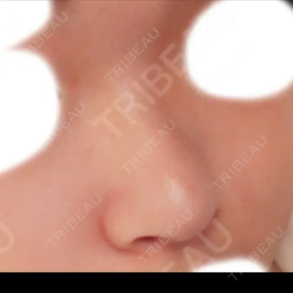 隆鼻術 / 鼻尖形成（切開） / 鼻中隔延長（切開） / 鼻尖縮小 FROM B整形外科 (旧バウム整形外科) BEFORE メイン用
