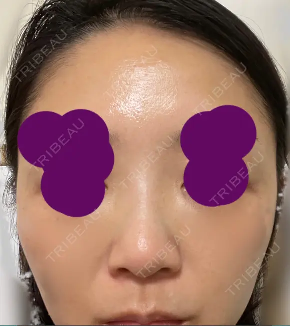 ヒアルロン酸注入（鼻） 新宿ビューティークリニック 新宿院 BEFORE メイン用