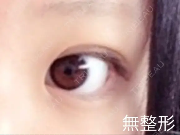 目頭切開 / 目尻切開 FROM B整形外科 (旧バウム整形外科) BEFORE メイン用