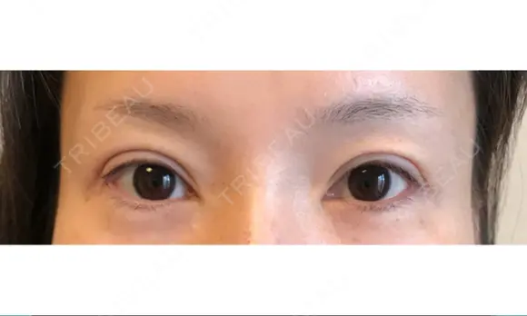 アートメイク（眉） GRACIA clinic 【グラシアクリニック】 BEFORE メイン用