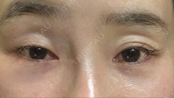二重切開 / 眼瞼下垂（切開） / クマ治療 / 上まぶたたるみ取り / 眉下切開 くさのたろうクリニック BEFORE メイン用