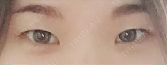 二重埋没 / 目頭切開 湘南美容クリニック 那覇院 BEFORE メイン用