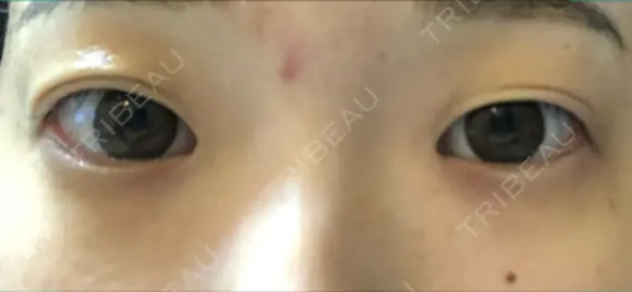 二重埋没 湘南美容クリニック 熊本院 BEFORE メイン用