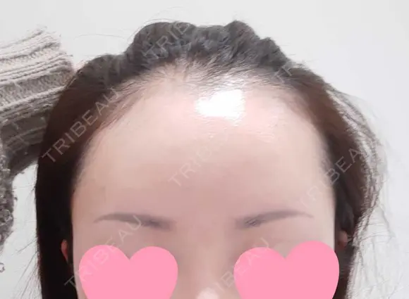 アートメイク（ヘアライン） トイトイトイクリニック 池袋院 BEFORE メイン用
