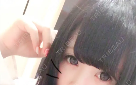 ヒアルロン酸注入（涙袋） プリモ麻布十番クリニック BEFORE メイン用