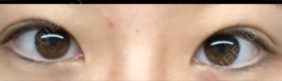 二重切開 湘南美容クリニック 藤沢院 BEFORE メイン用