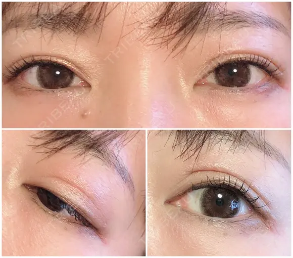 二重切開 北尾クリニック BEFORE メイン用