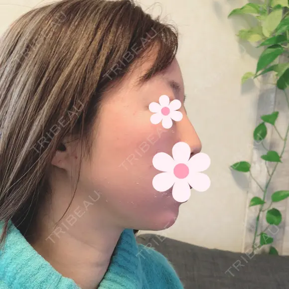 脂肪吸引（顔） 北尾クリニック BEFORE メイン用