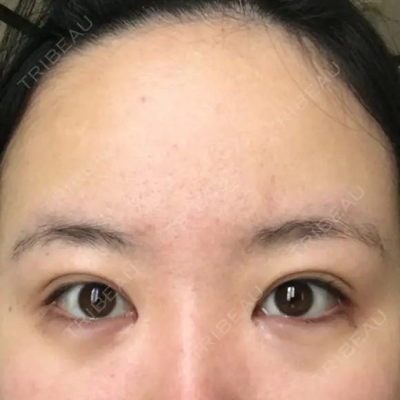 目尻切開 / タレ目形成・グラマラスライン（切開） B-LINE CLINIC 池袋院 BEFORE メイン用