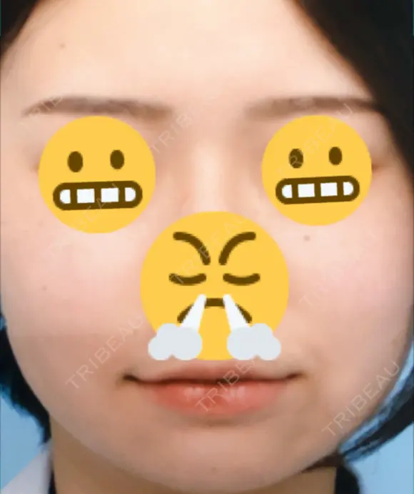 ほくろ・いぼ切除（肌） / ほくろ・いぼ除去レーザー（肌） 赤坂メディカルMクリニック BEFORE メイン用